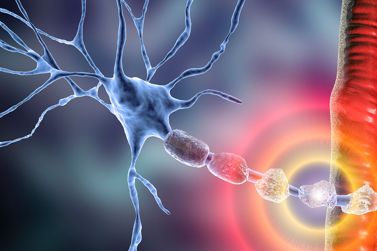 An image illustrating Neuromuscular conditions damage pathways between neurons.