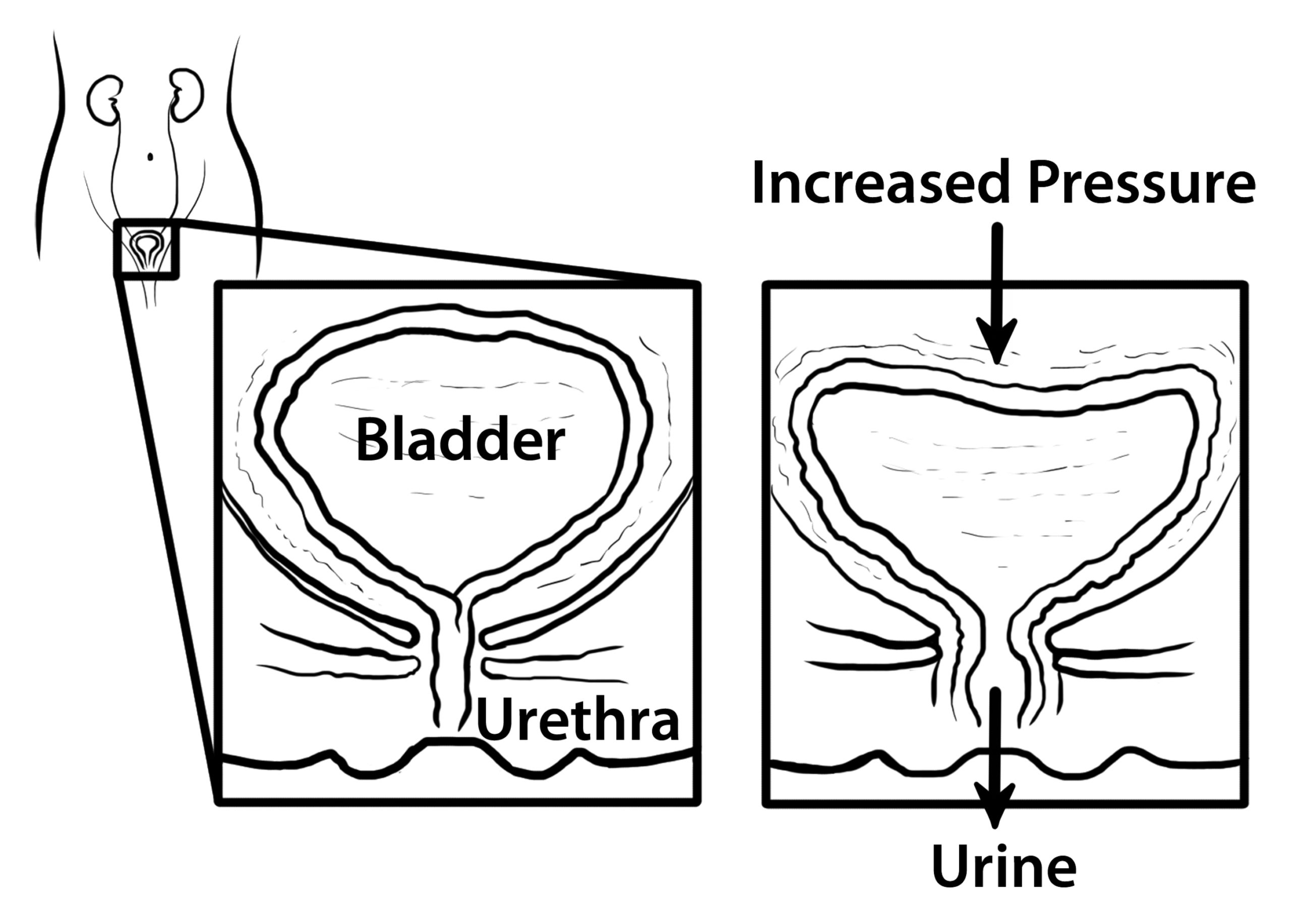 Image showing a normal bladder and pressure increased bladder for bladder cancer incontinence.